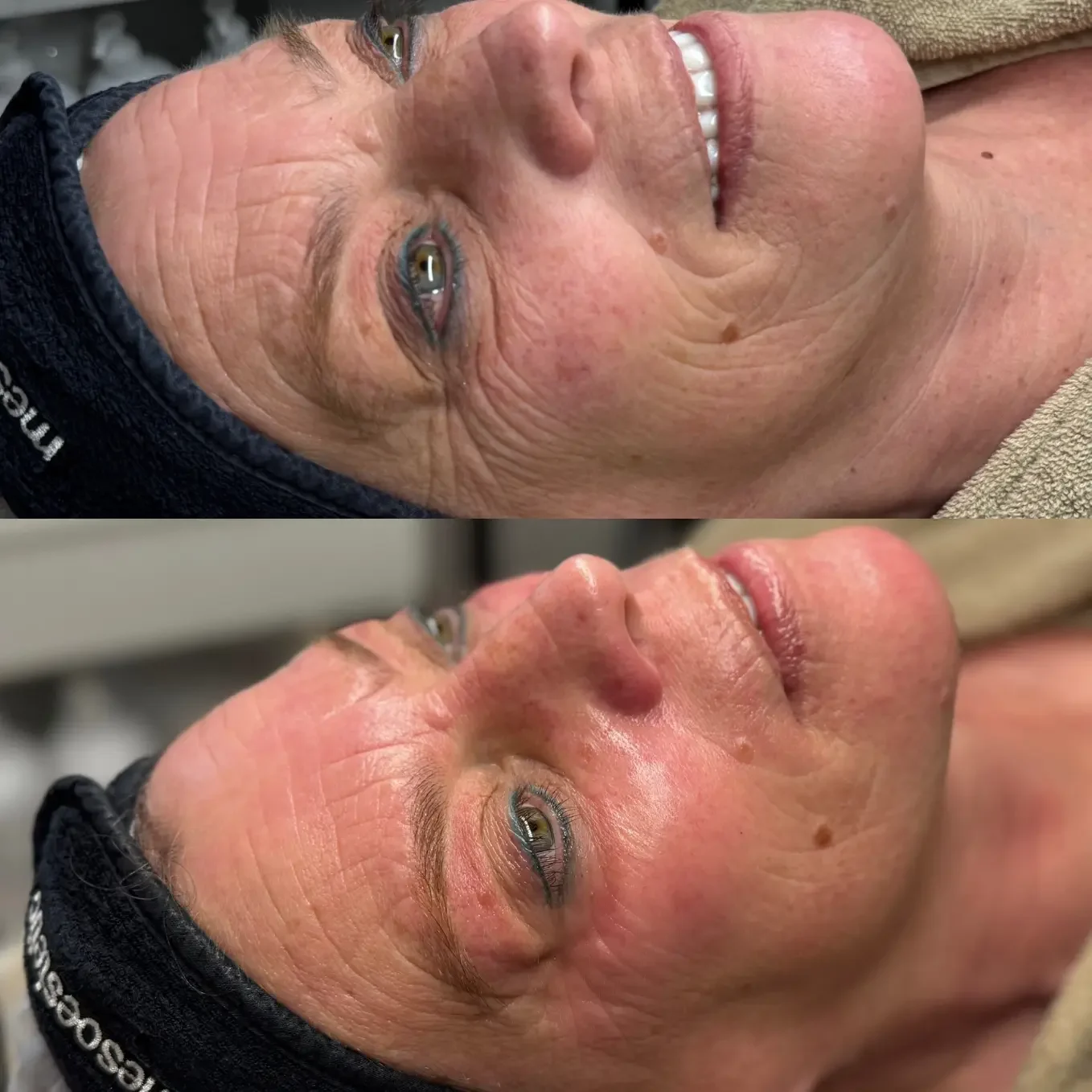 Voor en na resultaat van SkinPen microneedling behandeling bij Dermaé in Landgraaf.