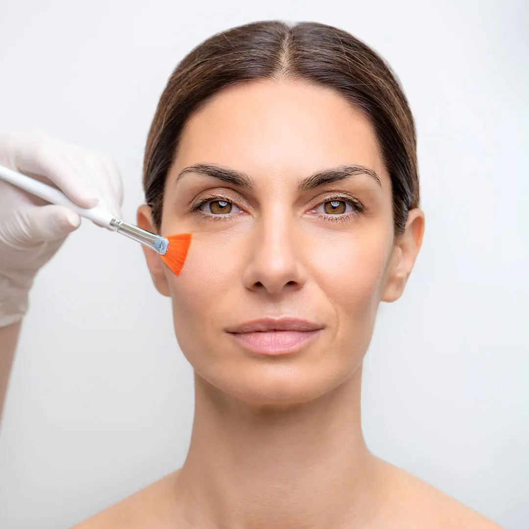 Peeling behandeling bij Dermaé in Landgraaf voor huidverbetering en verfijning van de huidstructuur.