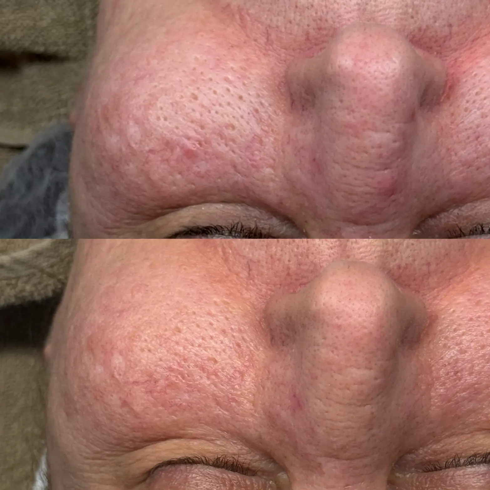 Voor en na resultaat van SkinPen microneedling behandeling bij Dermaé in Landgraaf.