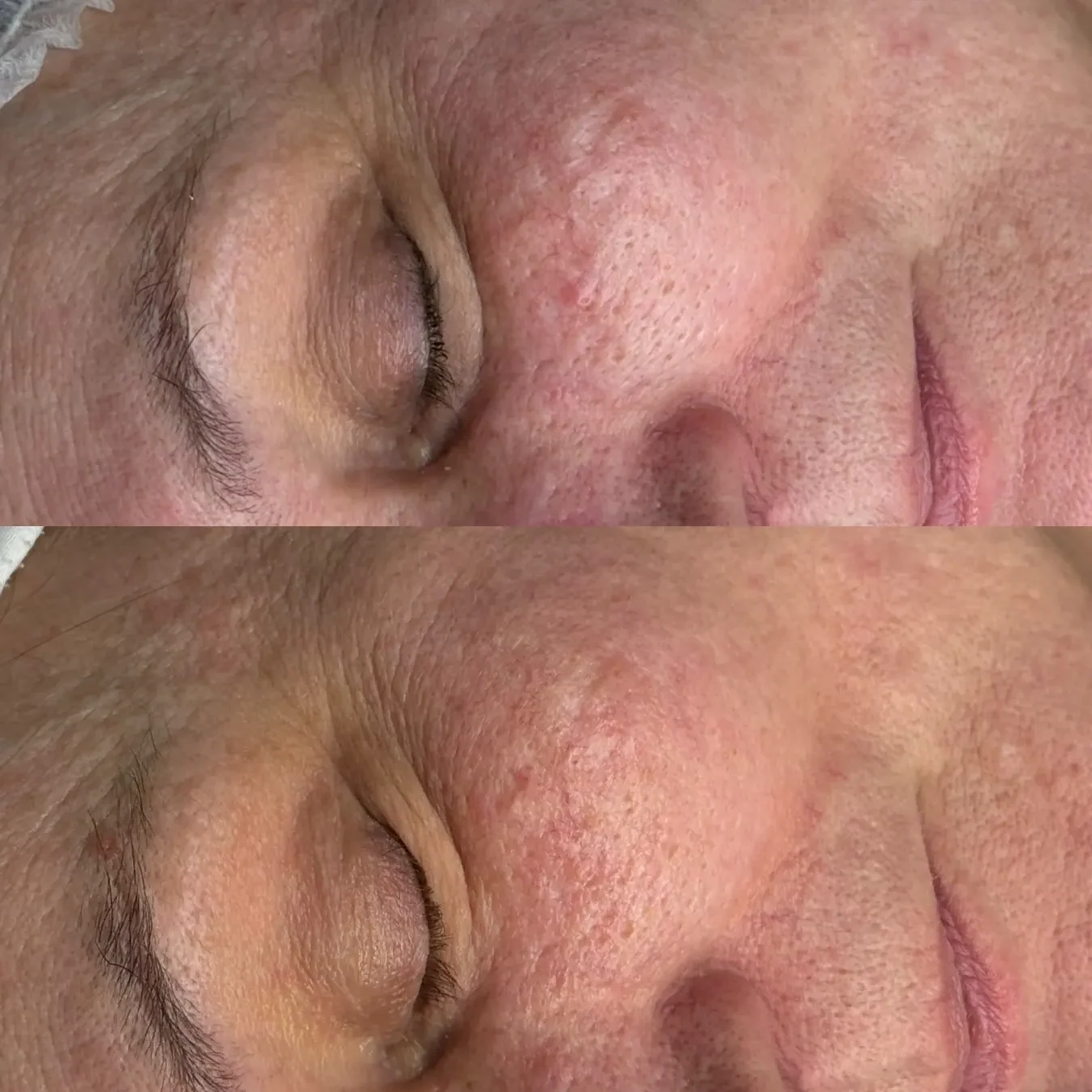 Voor en na foto van SkinPen microneedling model bij Dermaé in Landgraaf.